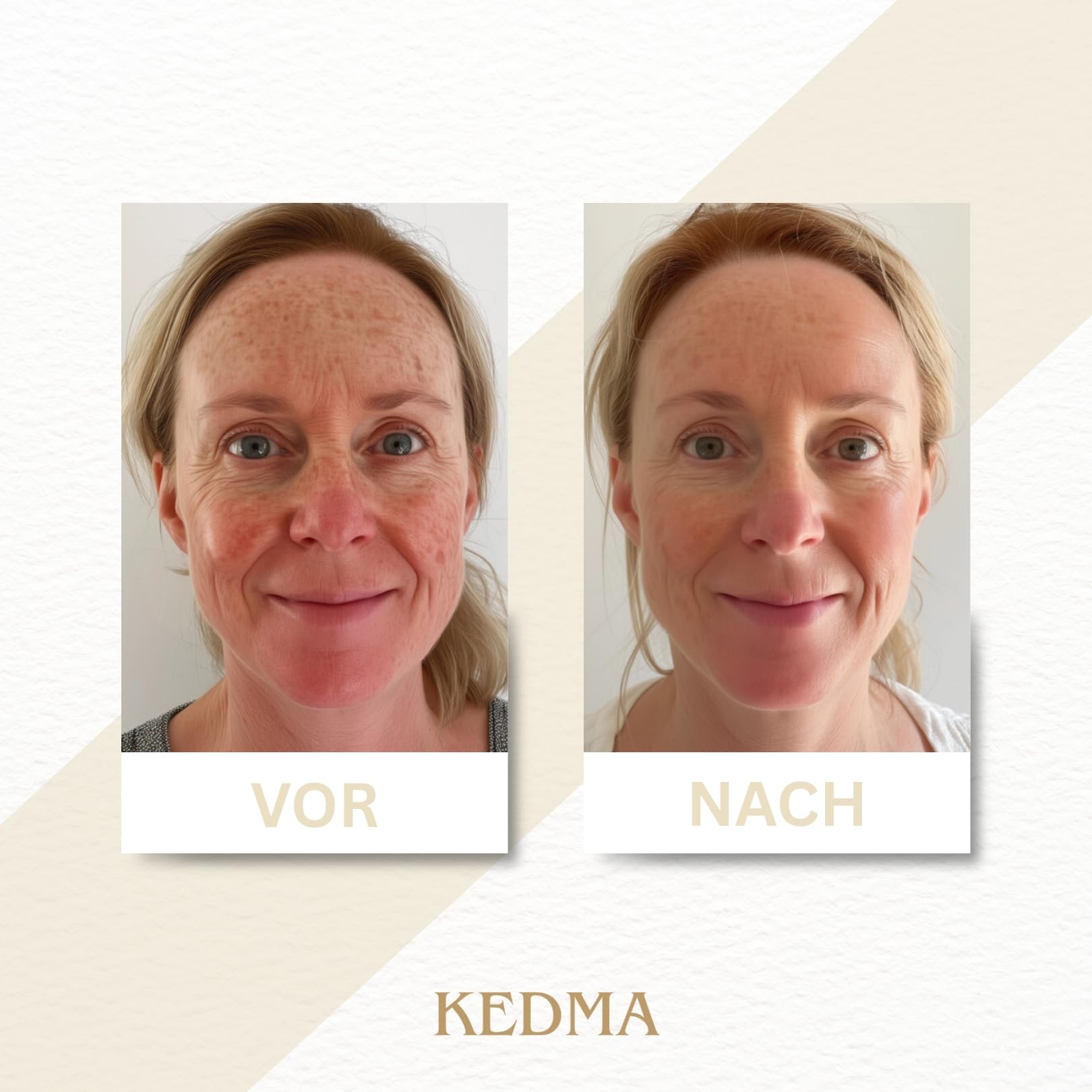 KEDMA - Aufhellender Peeling-Booster mit AHA - 50ml | AHA-Peeling-Booster exfoliert sanft, glättet die Hautstruktur und unterstützt einen ebenmäßigen, strahlenden Teint.
