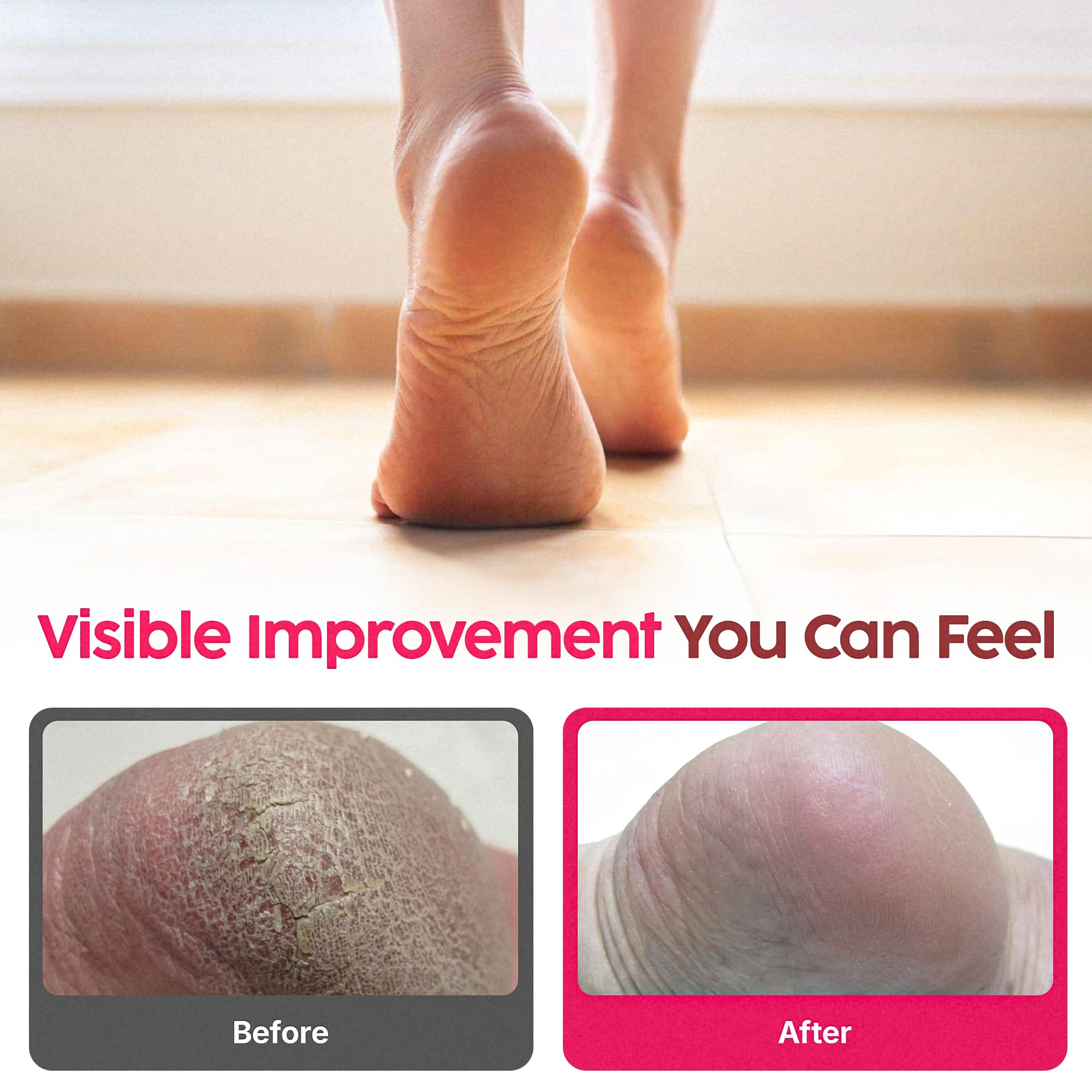 FOOTLOGIX Rough Skin Formula Foot Mousse with Urea, Spiraleen, Tea Tree Oil & Aloe Vera