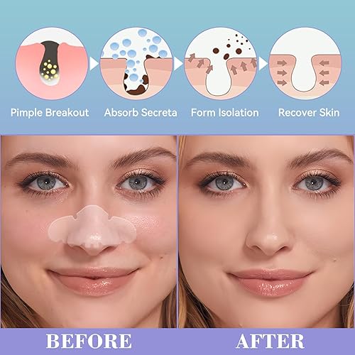 Miniatura 2 de Parches para poros de nariz, parches hidrocoloides nasales, granos, poros y aceite (paquete de 5)