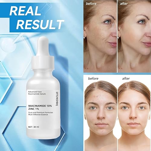 Miniatura 6 de Suero facial de nicotinamida 10% + zinc 1%, suero facial refrescante de nicotinamida para mujer, suero facial de nicotinamida para aliviar el acné.