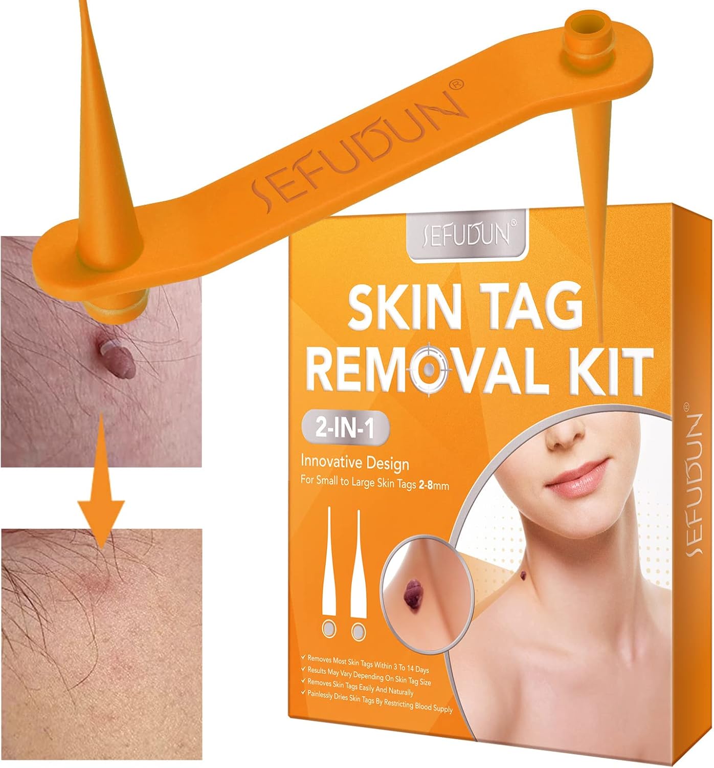Physical Auto Micro Skin Tag Tool Remover Kit,Premier Quality Skin Tag