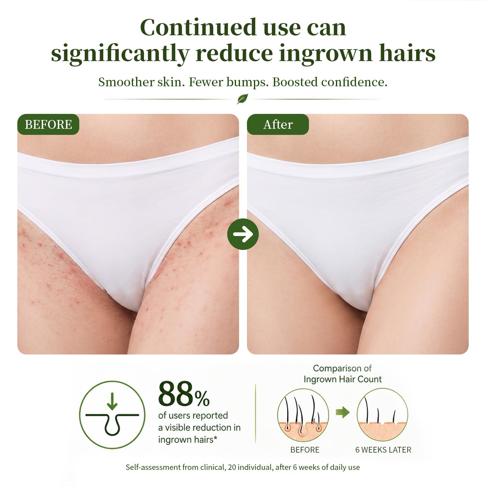 Öl Serum für eingewachsene Haare: 48 g, beruhigendes After Shave Öl, verhindert eingewachsene Haare zur Beruhigung von Rasiererbeulen, reduziert Rötungen und Irritationen für Bikinizone, Beine