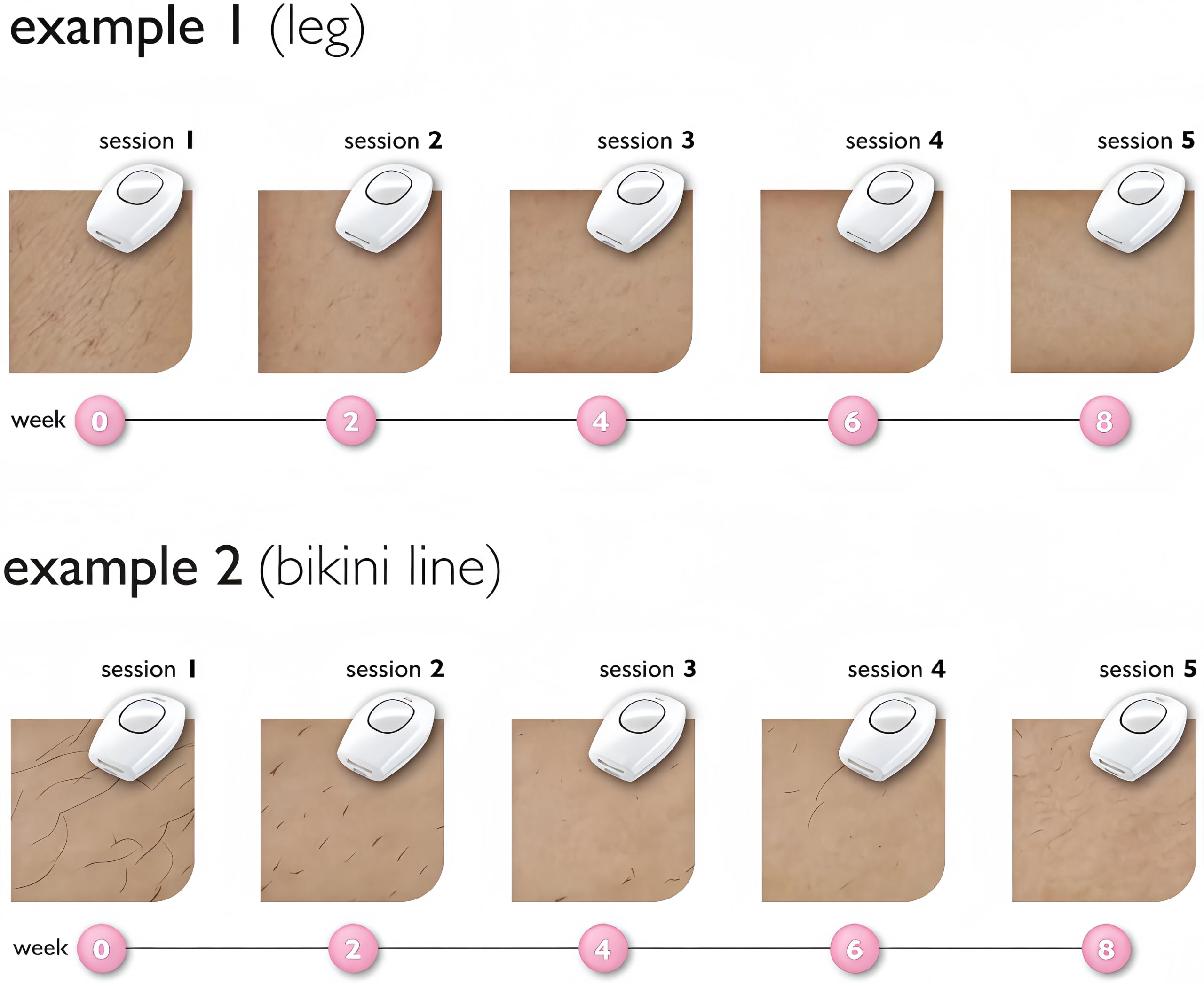Solippy LOOP Appareil d'Épilation IPL, Épilation Laser Indolore, Lumière Pulsée pour Épilation Définie du Visage, Corps, Bikini et Aisselles, Épilateur Électrique Pratique et Efficace