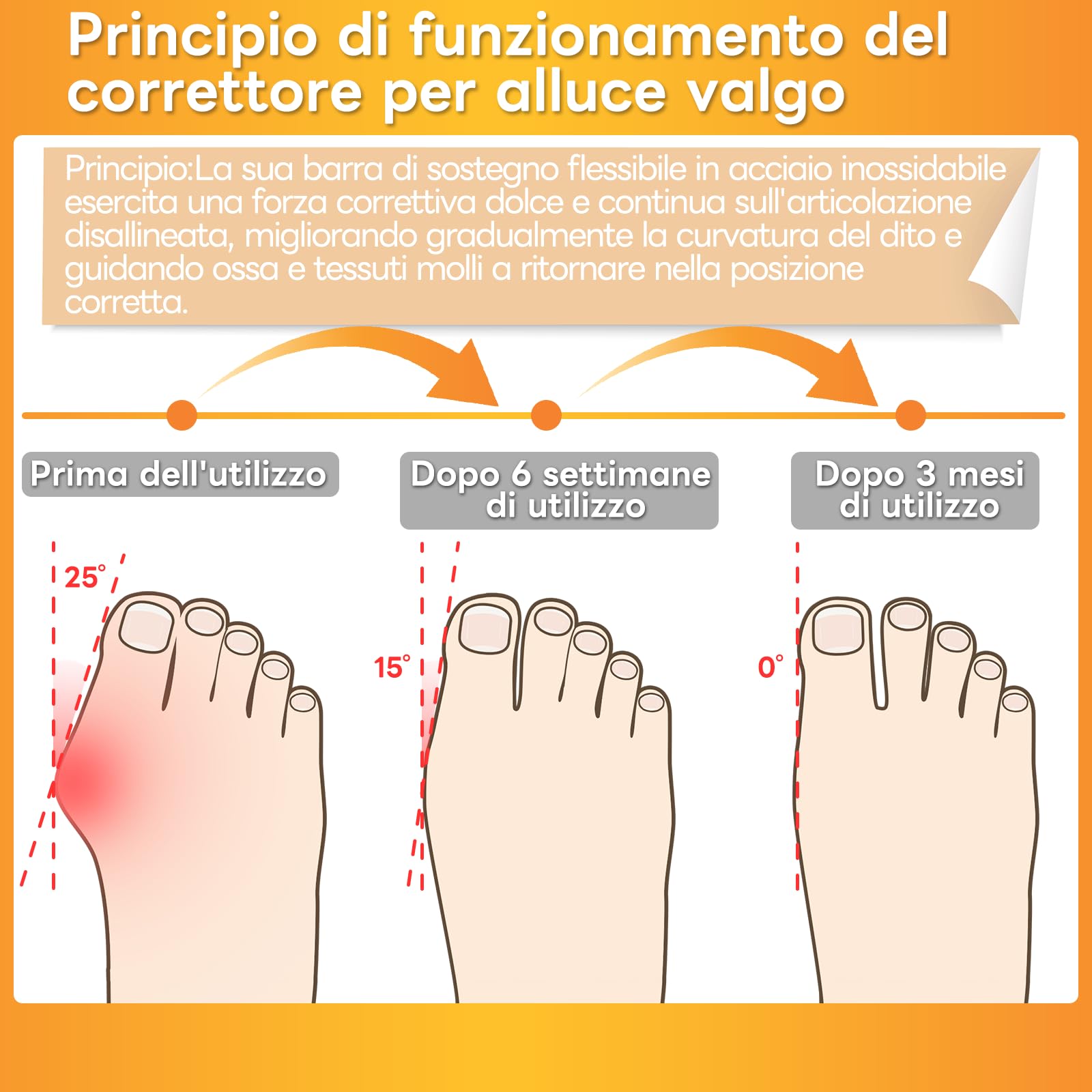 InhwRior Correttore per alluce valgo — dotato di 4 barre flessibili in acciaio inossidabile, con cuscinetto in silicone, migliora la condizione del piede senza dolore, utilizzabile con le scarpe