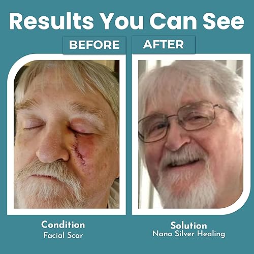 Vista 17 de OPTIVIDA Gel de plata coloidal para el cuidado de heridas, curación tópica natural de la piel Gel tópico de nano-plata para heridas, quemaduras