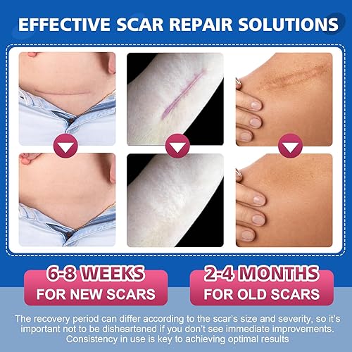 Miniatura 3 de Hojas de silicona para cicatrices, cinta para cicatrices quirúrgicas, cesárea, abdominoplastia, queloides, cinta facial para arrugas durante la