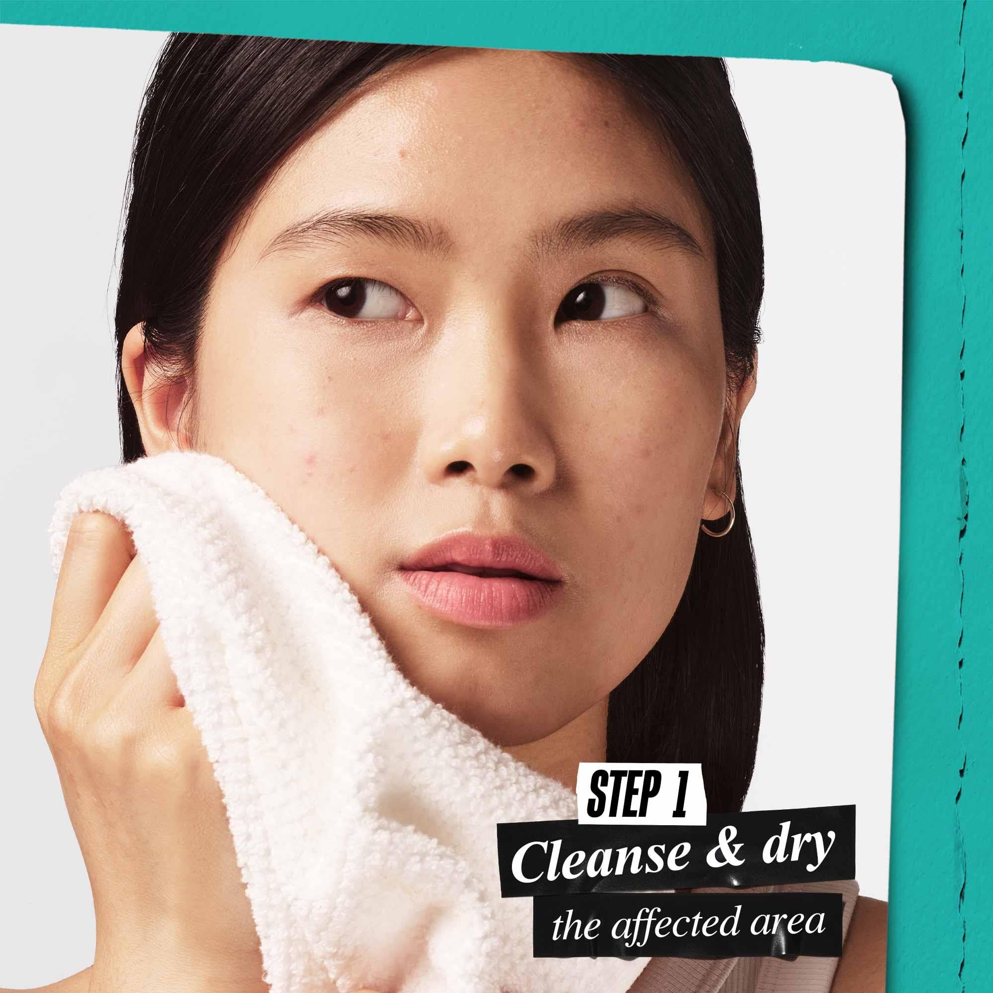 Kiehl's Truly Targeted Overnight Blemish Patch, Hydrocolloid Patch for Blemishes — view 4