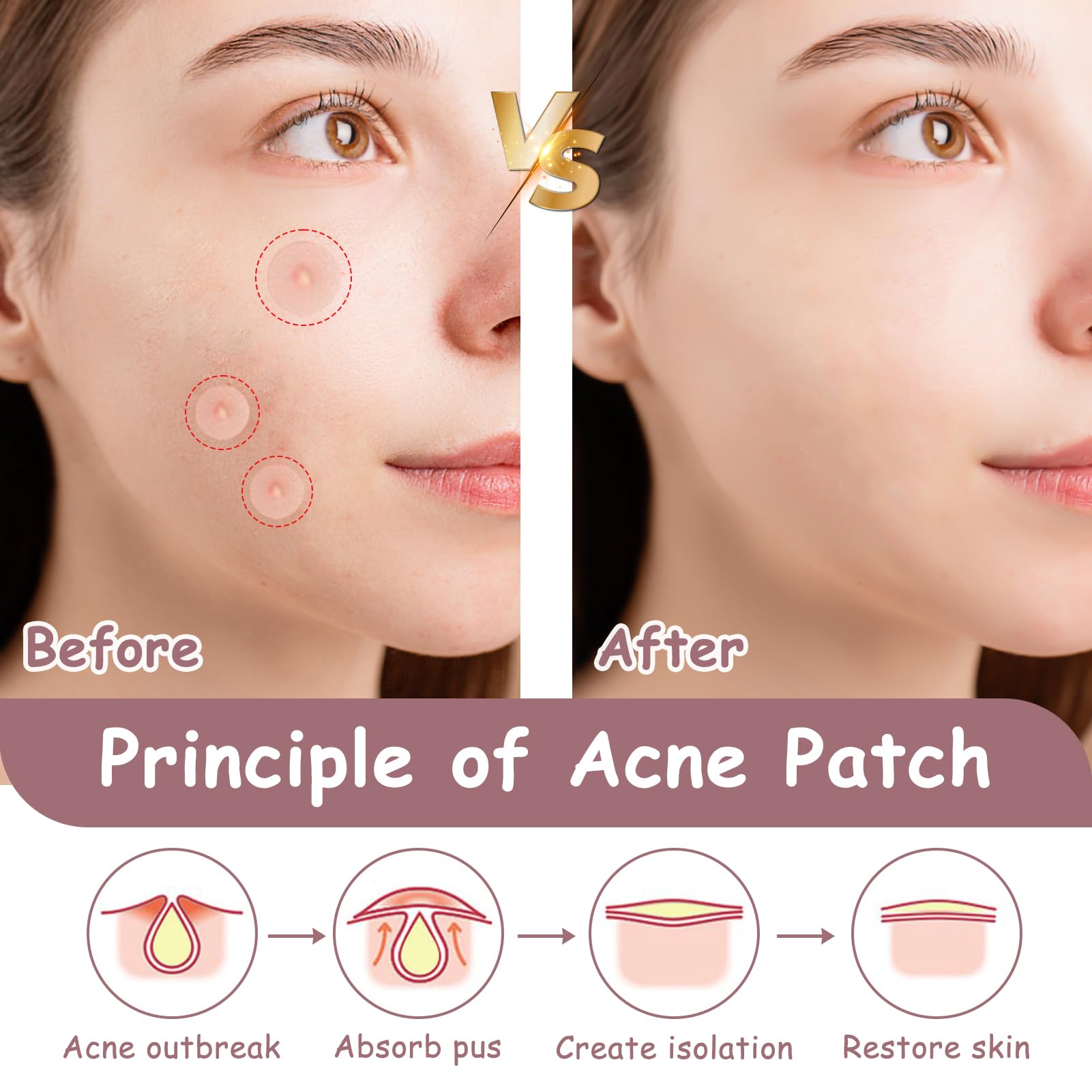 360 Piezas Parches para Acné Hidrocoloides, Parches para Granos Día y Noche, Pimple Patch Parches Anti Acne Impermeables Transpirables, Absorbe el Pus Reduce Cicatrices, Todo Tipo de Piel 10mm/12mm