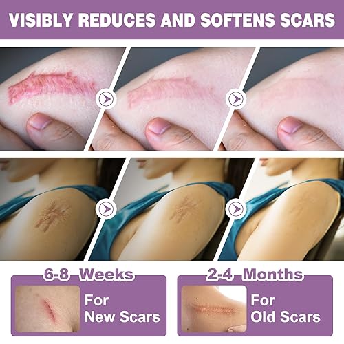 Miniatura 5 de Hojas de silicona para cicatrices, 2 rollos, cinta de silicona para cicatrices (rollo de 1.6 x 120 pulgadas, 9.8 ft), tiras de silicona de grado