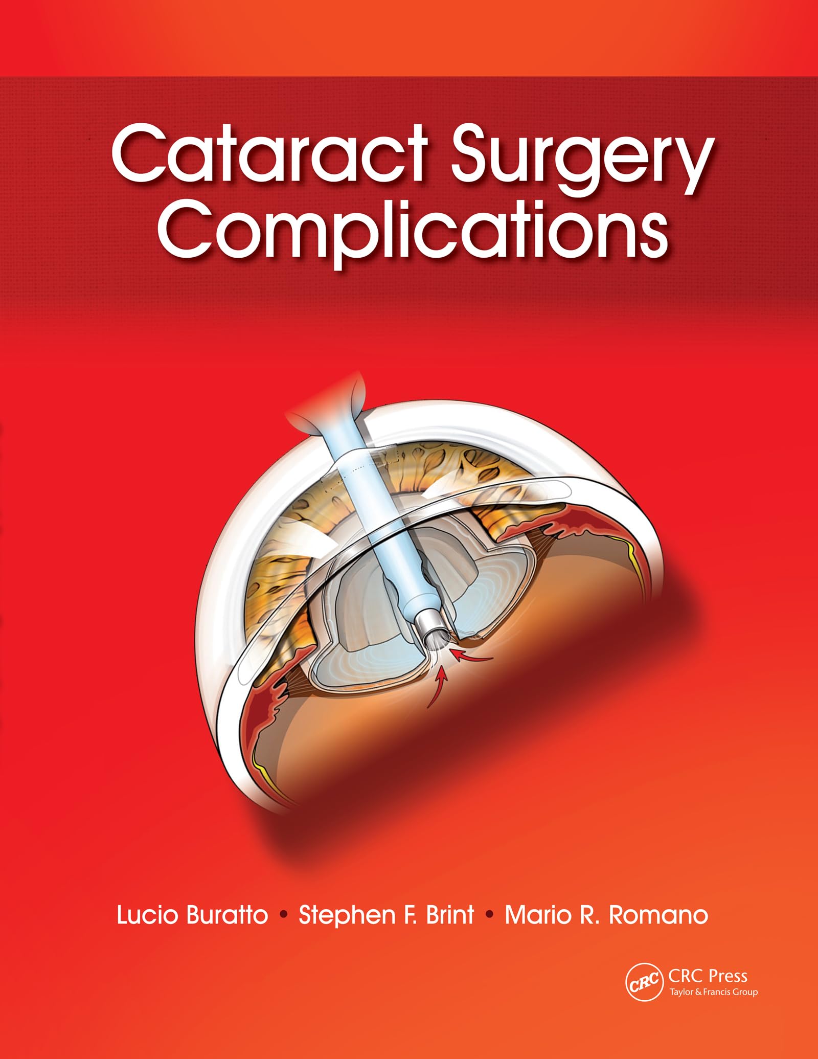 Cataract Surgery Complications (English Edition)