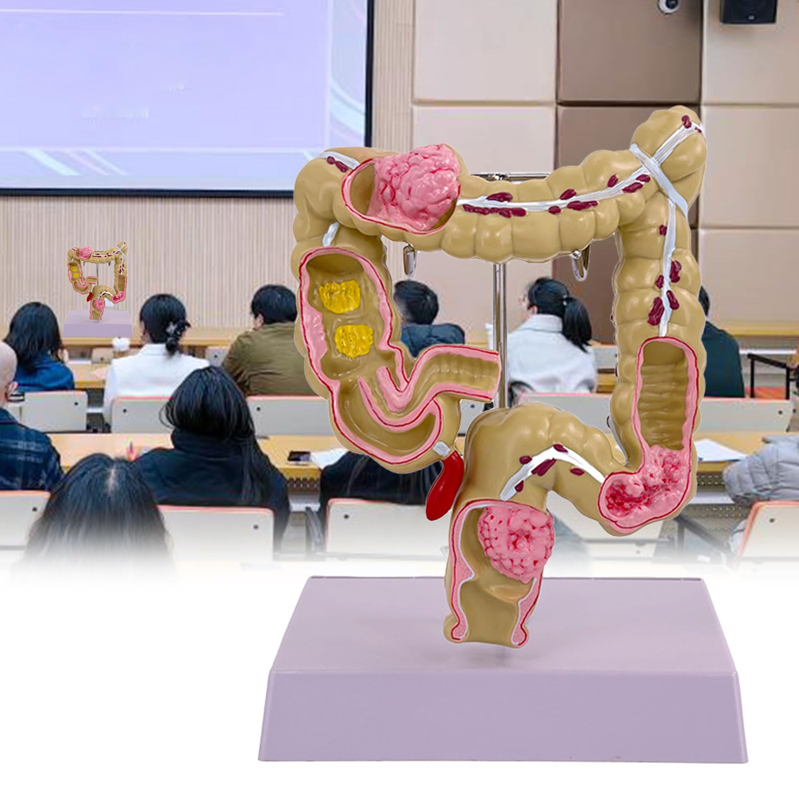 Modello umano dell'intestino crasso Patologie umane del modello dell'intestino crasso Strumento didattico per studi scolastici di laboratorio Patologie del modello dell'intestino crasso Modello di