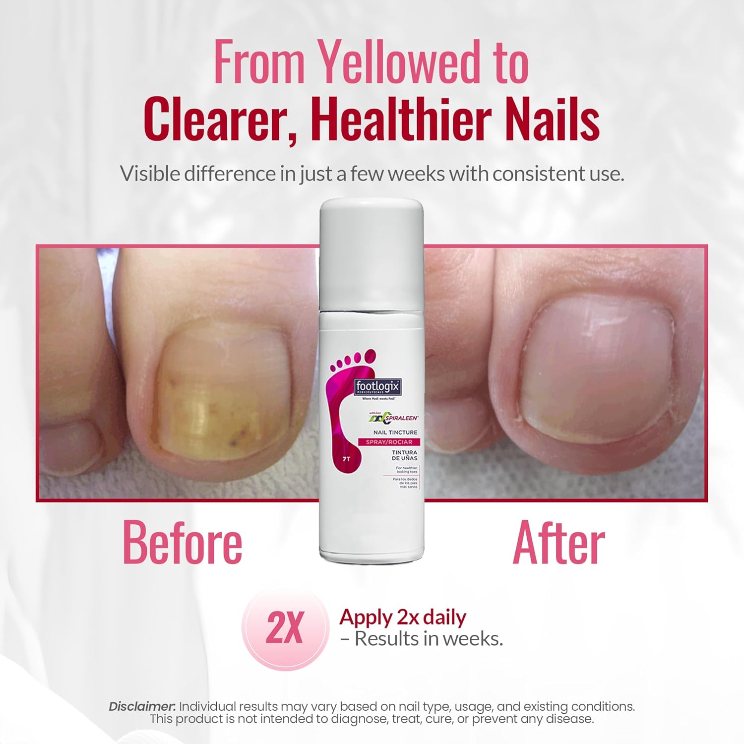 FOOTLOGIX Nail Tincture Spray with Spiraleen, 1.69 Fl Oz (Pack of 1) - Image 4