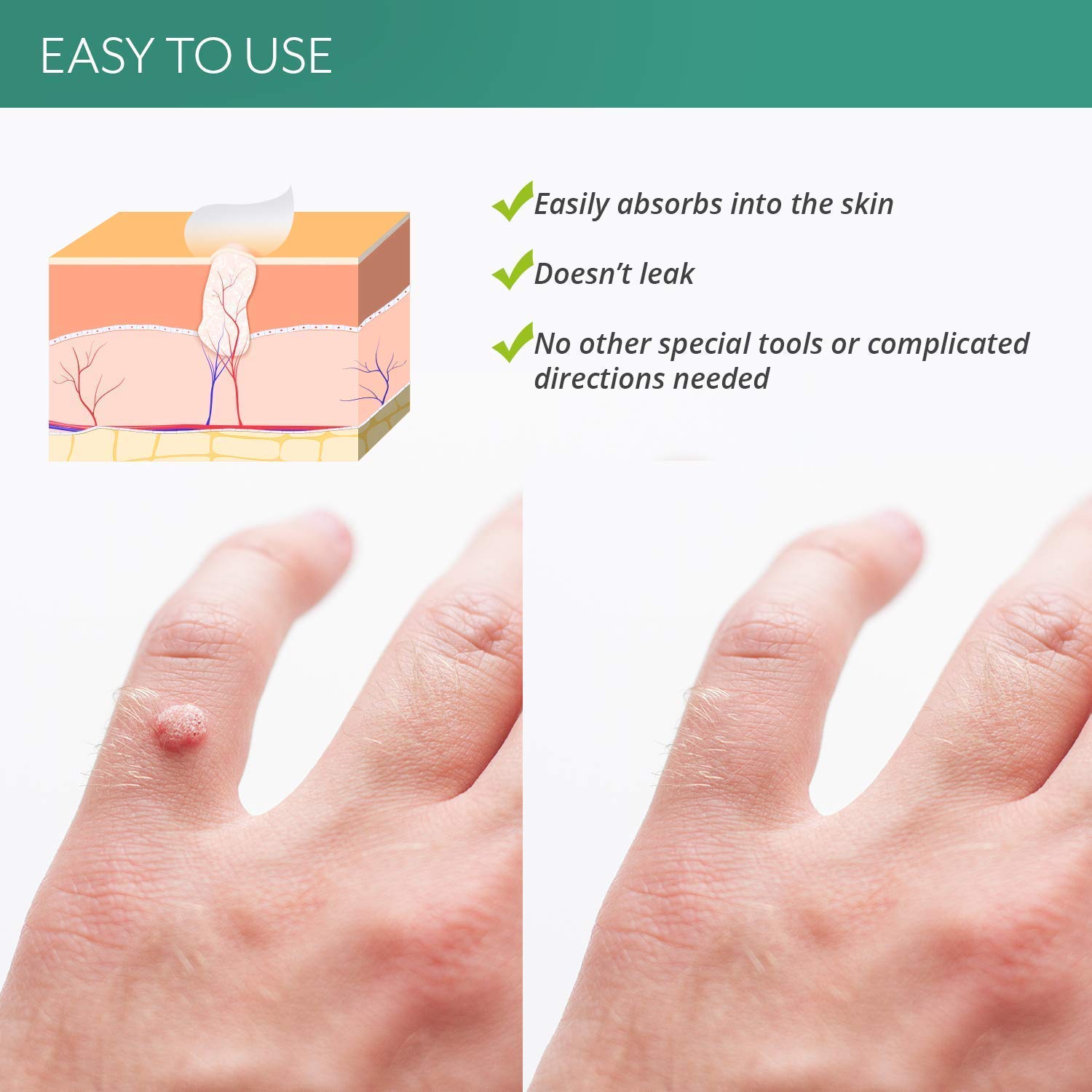 BEALUZ Wart Remover Fast Acting Gel Effectively Remove Flat Warts