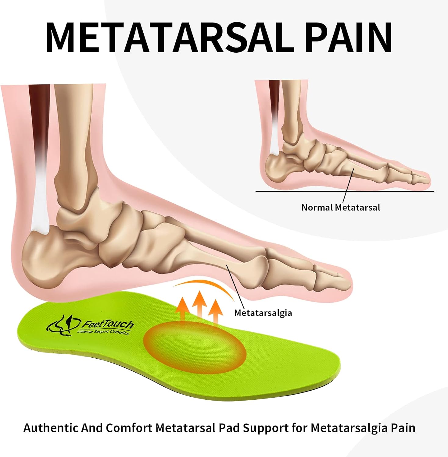 Strong Arch Support Orthotics for Metatarsalgia Morton's Neuroma