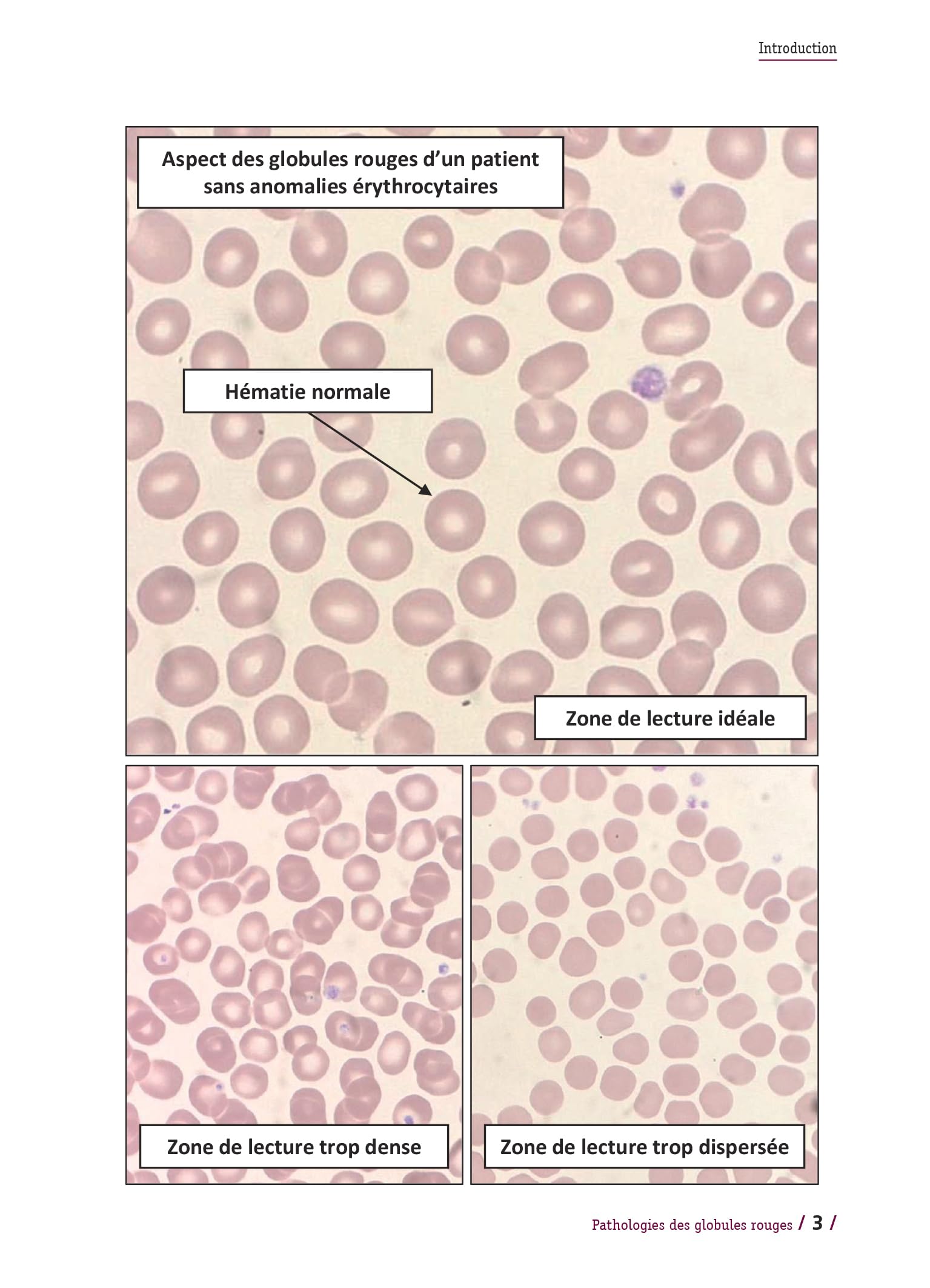 Pathologies des globules rouges: Glossaire illustré en 50 fiches