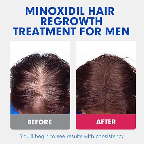Miniatura 6 de 5% de minoxidil para hombres tratamiento de crecimiento del cabello, solución tópica extra fuerte para adelgazamiento del cabello y calvicie,