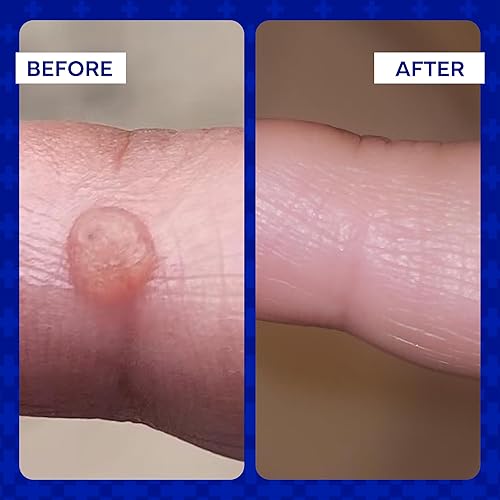 Miniatura 9 de EMUAID Ungüento - Crema para eccema Tratamiento de fuerza regular Fuerza regular para pies de atletas psoriasis picazón antipicazón erupción herpes