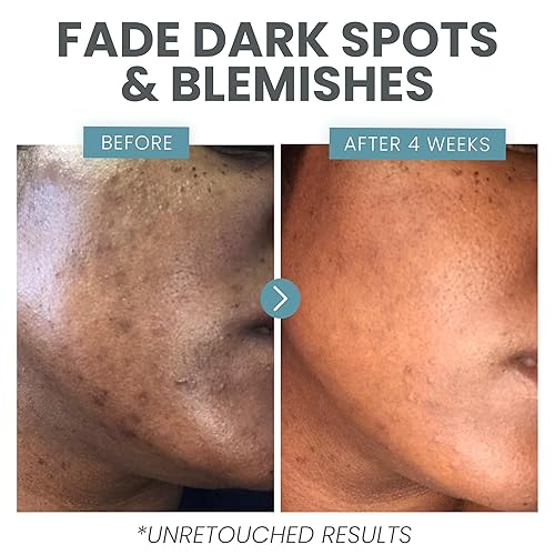 Miniatura 6 de Vitamina C para la cara, suero para limpiar la piel con ácido salicílico, retinol, niacinamida y ácido hialurónico, aclarante de la piel, antiacné,