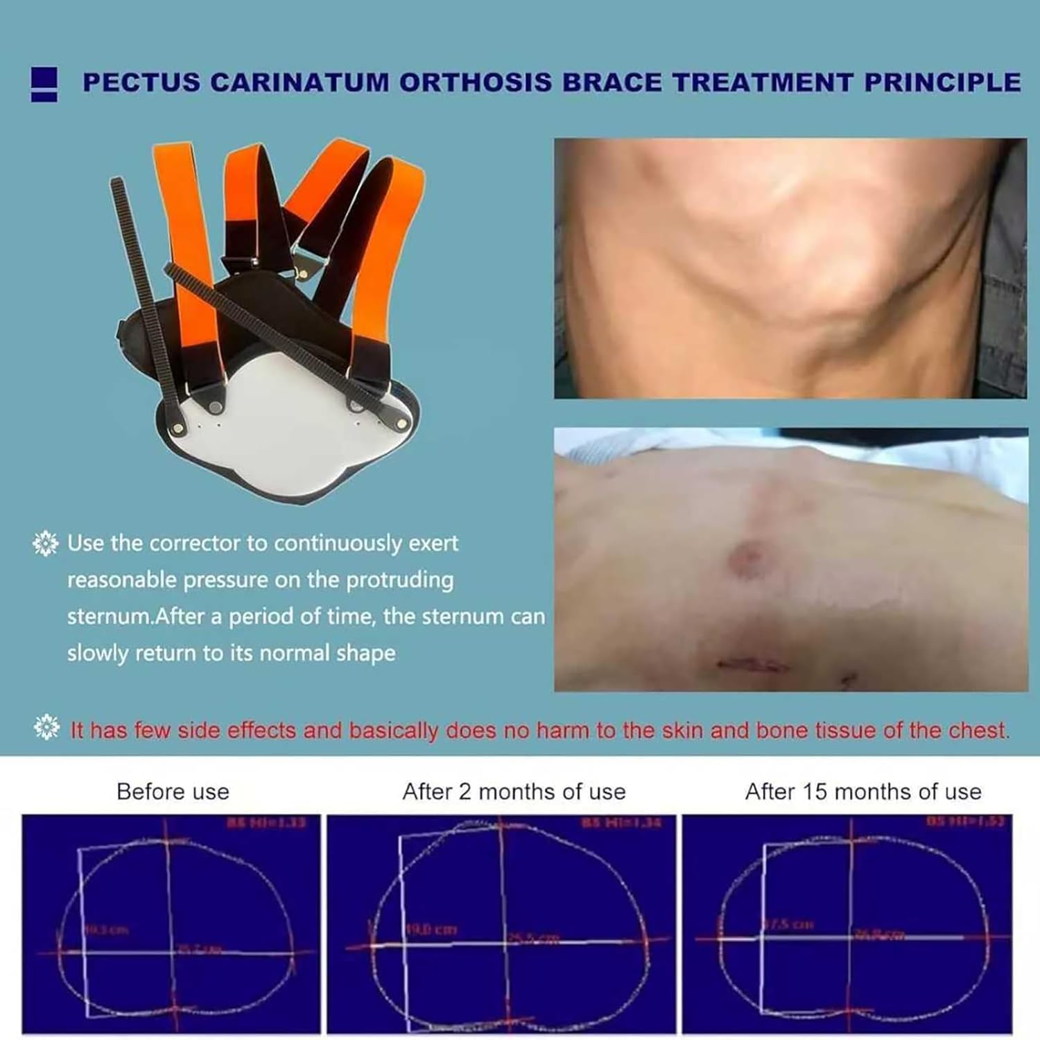 Pectus Carinatum Orthosis Brace, Adjustable Pigeon Chest Orthosis Support,with Size Adjuster and Anti-Slip Design, Removable, for Congenital Pigeon Chest (M)