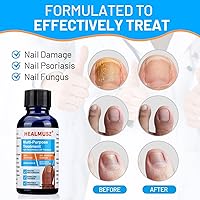 Vista 2 de Tratamiento de hongos en las uñas extra fuerte – Reparación de acción rápida para uñas saludables.