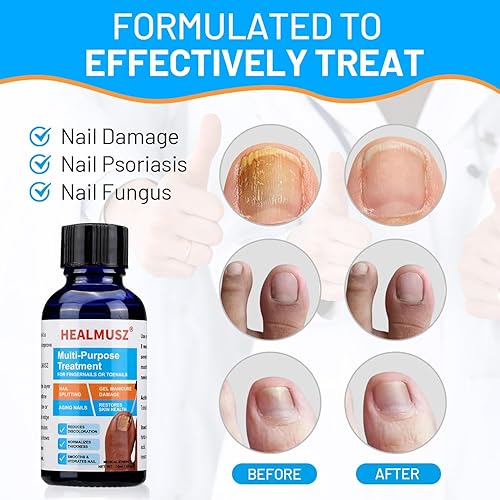 Miniatura 2 de Tratamiento de hongos en las uñas de los pies extra fuerte, tratamiento de hongos en las uñas de los pies, tratamiento de pies de atletas,