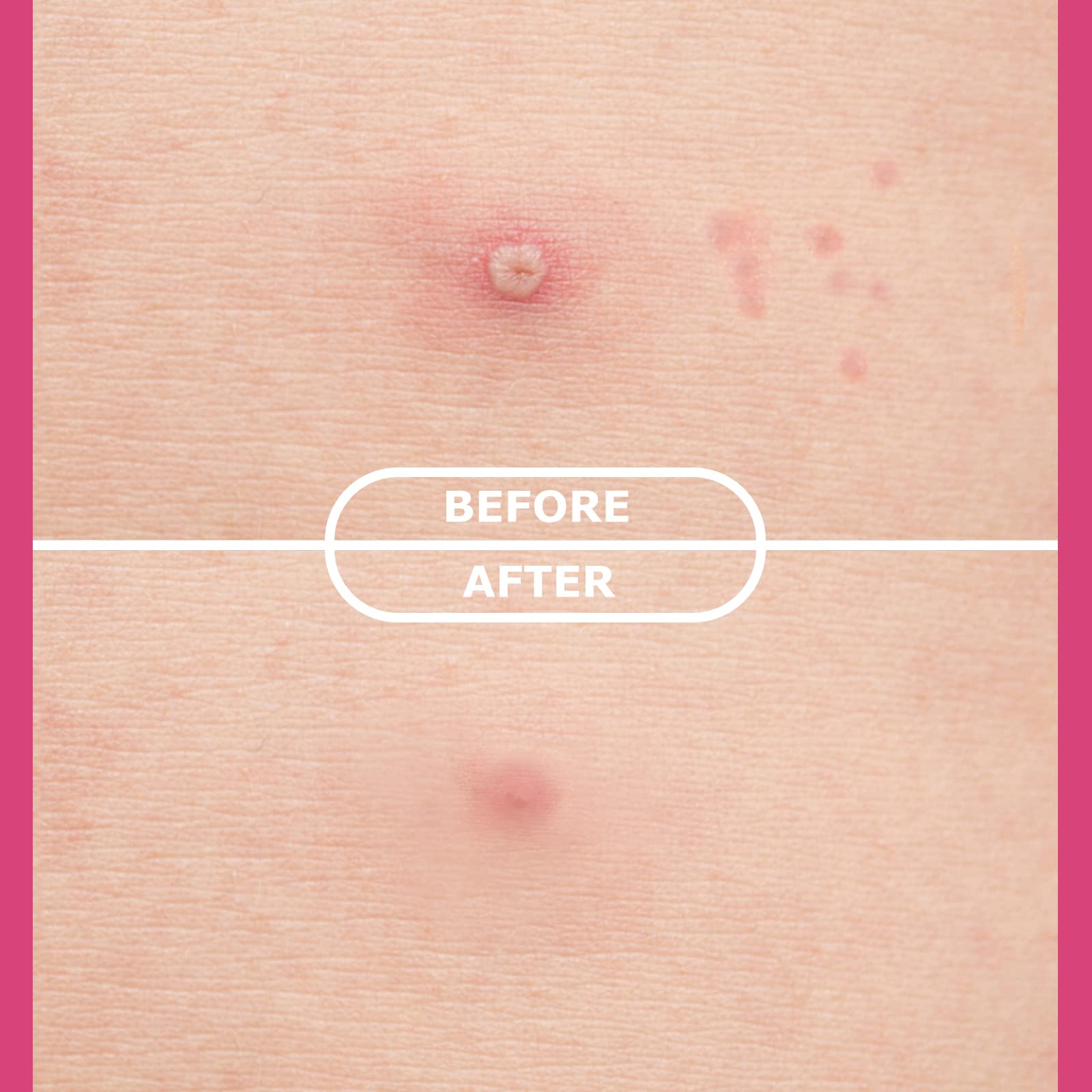 AUSLKA Pimple Blemish plastry hydrokoloidowe na pryszcze 112 szt