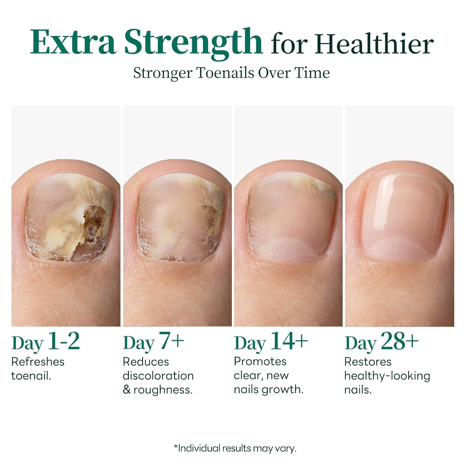 Apuree Antifungal Pen Extra Strength: 25% Undecylenic Acid 1% Tolnaftate| FSA-HSA| 24/7 Day & Night Care | 2Pcs Nail Fungus Pen | Nail Treatment Repair For Damaged Yellow Discolored Thick Nails