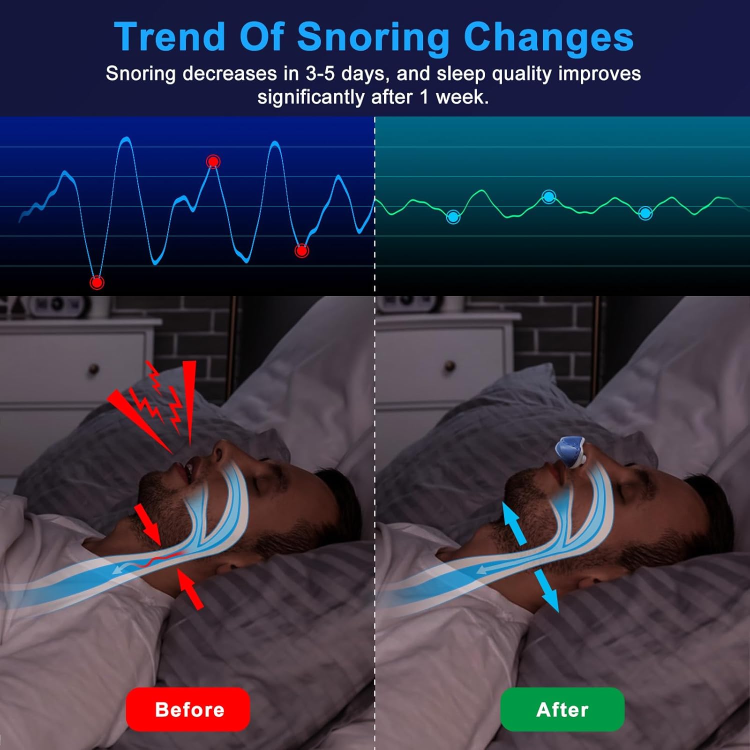 Anti Snoring Device - Mini SleepApnea Devices - Variable Anti Snoring Aid - Upgraded Stop Snoring Solution - Suitable for All Nose Shapes - Blue - YD1 - Image 3