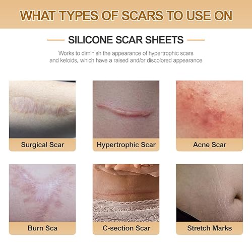 Miniatura 2 de Hojas de silicona para cicatrices, cinta de silicona para cicatrices, hojas de silicona para cicatrices (rollo de 1.6 x 59 pulgadas - 4.9 ft) sin