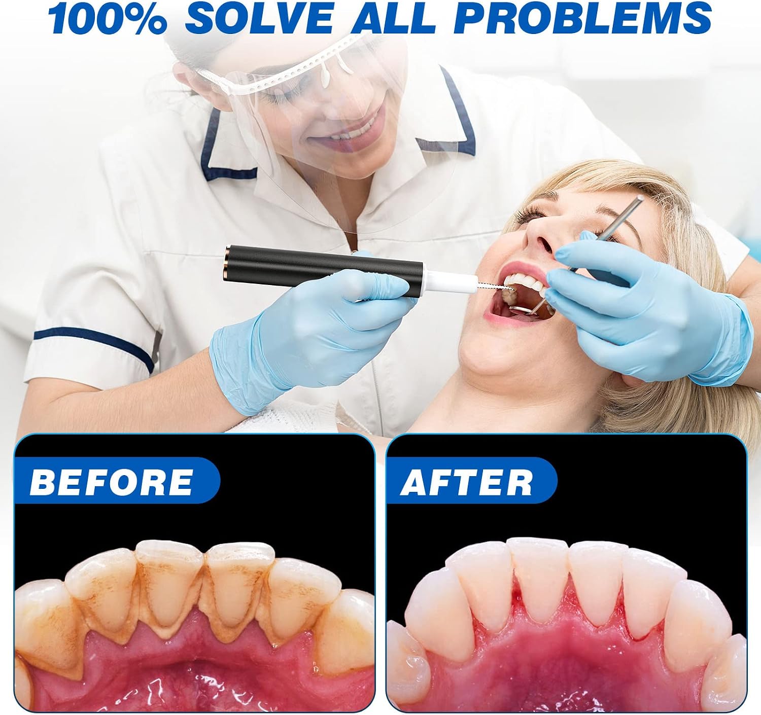 Before and after images of teeth cleaning using the HassoKon device.