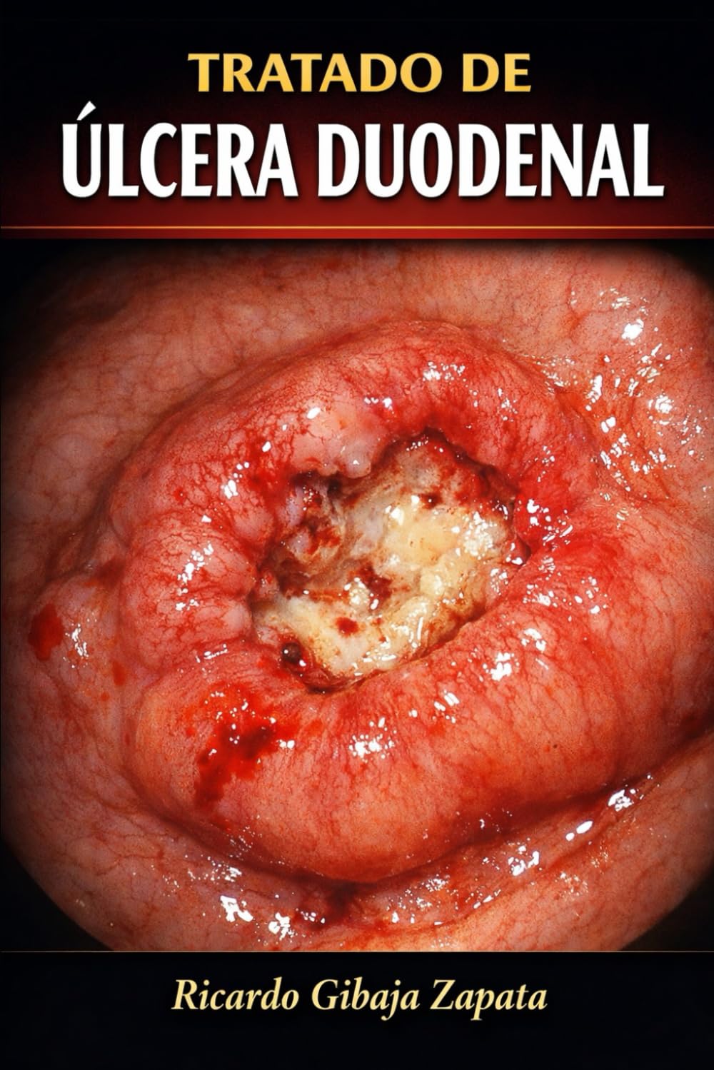 TRATADO DE ULCERA DUODENAL