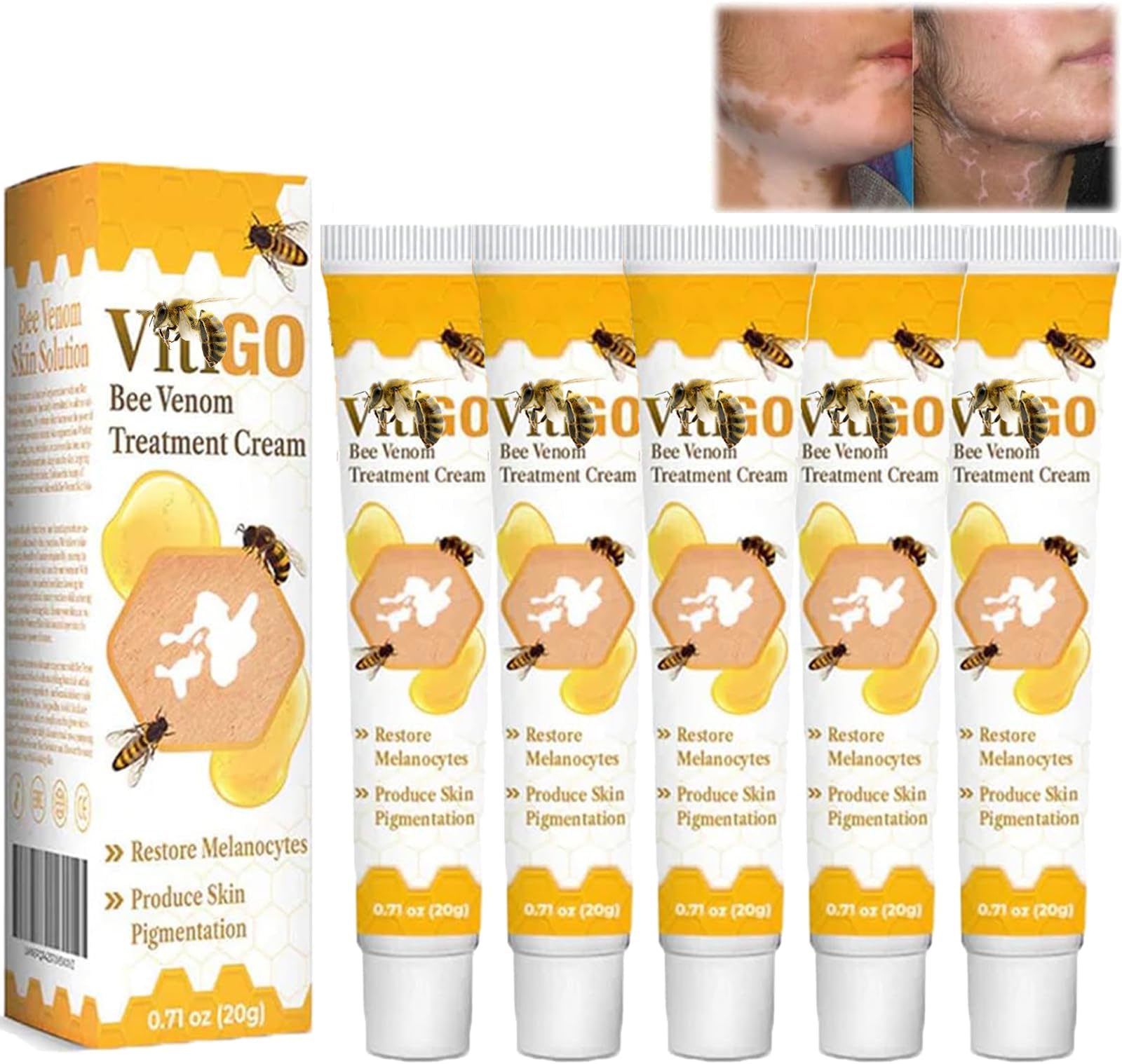 Vitiligo Bee Venom Treatment Cream (5pcs)