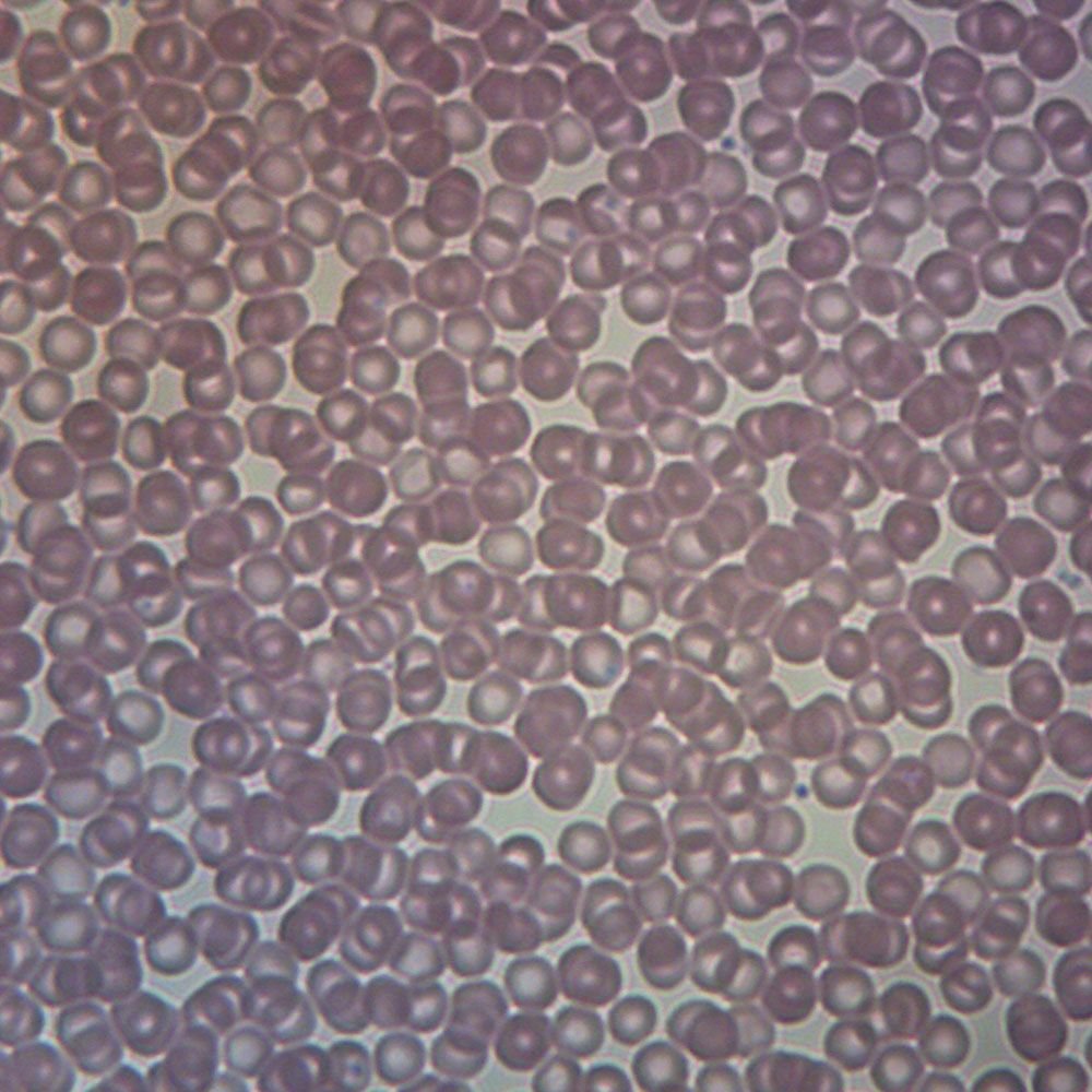 Human Iron Deficiency Anemia, Smear Microscope Slide