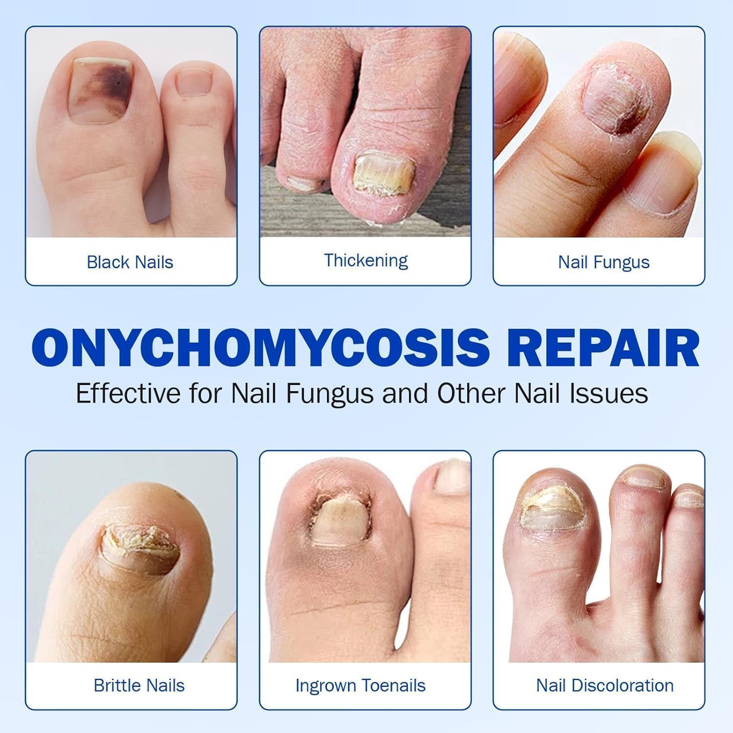 Advanced Fungal Nail Patch Treatment – Powerful Antifungal Solution | Targets Nail Fungus at the Root | Easy-to-Use Patch for Toenail & Fingernail | 20 Patches (40, FREE ALL) - Image 7 thumbnail