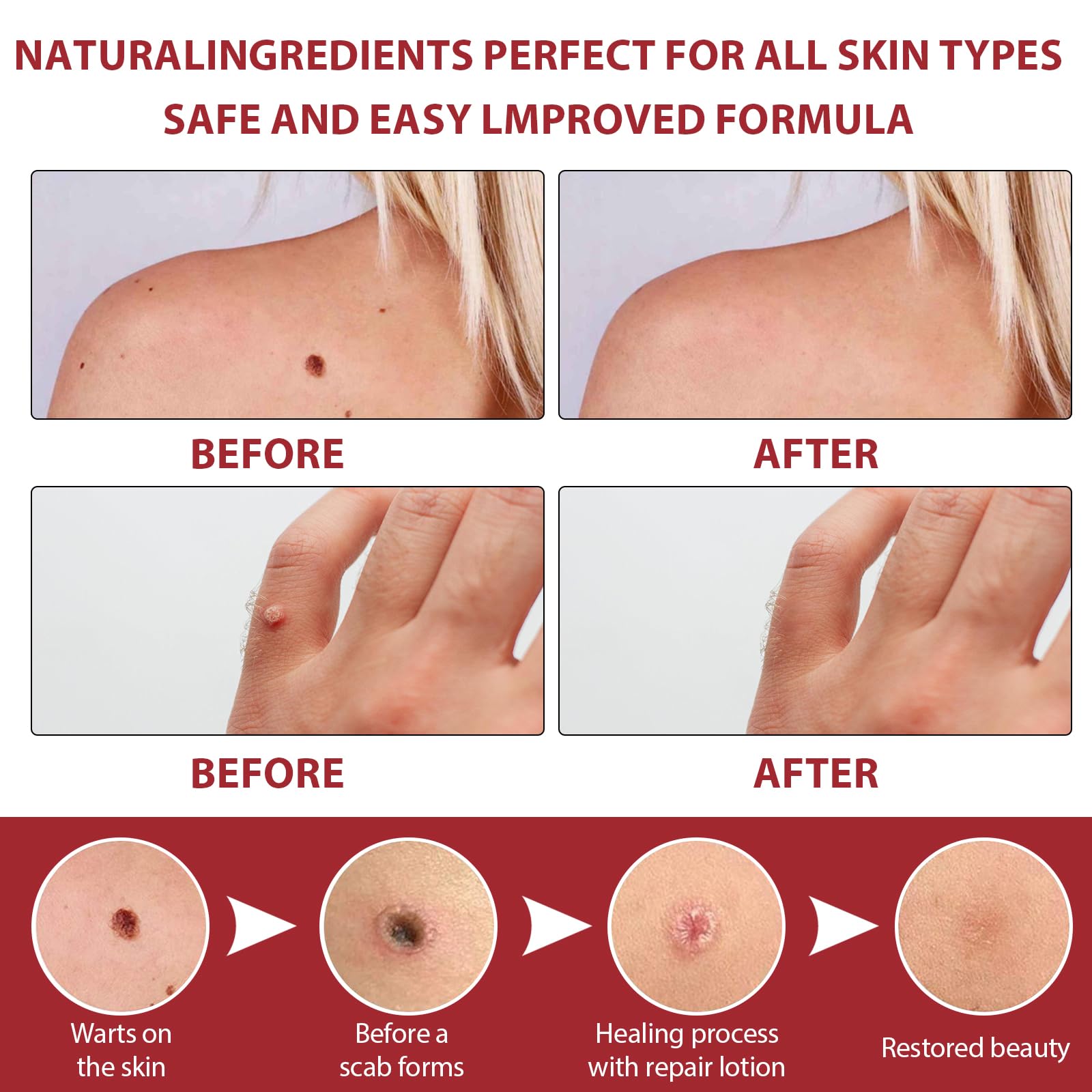 20g Eliminador De La Piel Verrugas Crema, Eliminación las Verrugas en los pies, Manos y Cuerpo, Atención Diaria, Adecuado para Partes del cuerpo