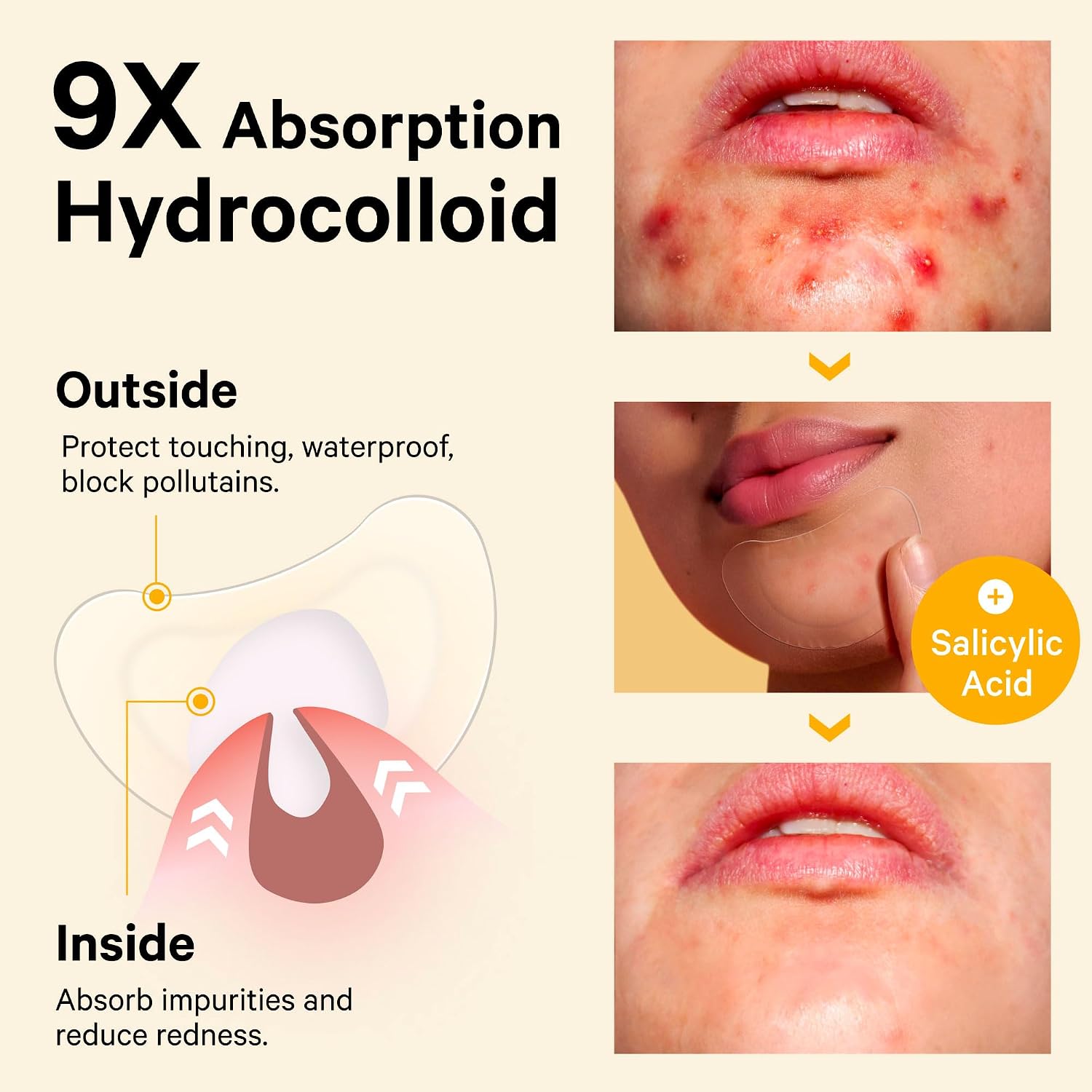 Sosky Chin Pimple Patches Hydrocolloid Acne Patches for Breakouts Large Spot Control Covers for Face Chin & Body Vegan Cruelty Free (10 Count)