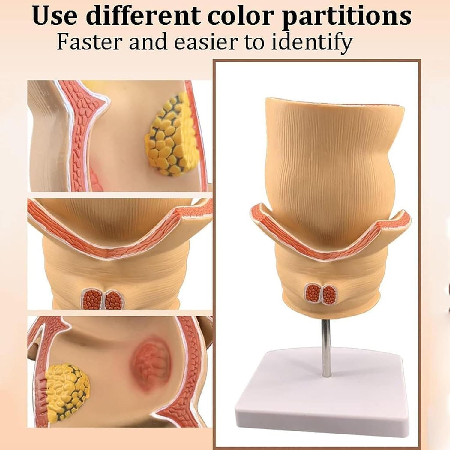 Rectal Ulcer Anatomical Model,Anatomical Human Rectum Pathology Lesion Model Hemorrhoids Anus Medical Teaching