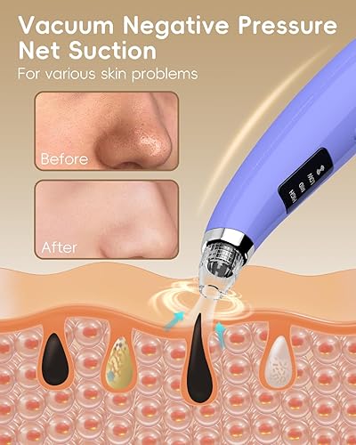 Miniatura 3 de Removedores de vacío de puntos negros, aspiradora de poros para cara con 5 accesorios y 3 niveles de succión, herramientas recargables por USB para