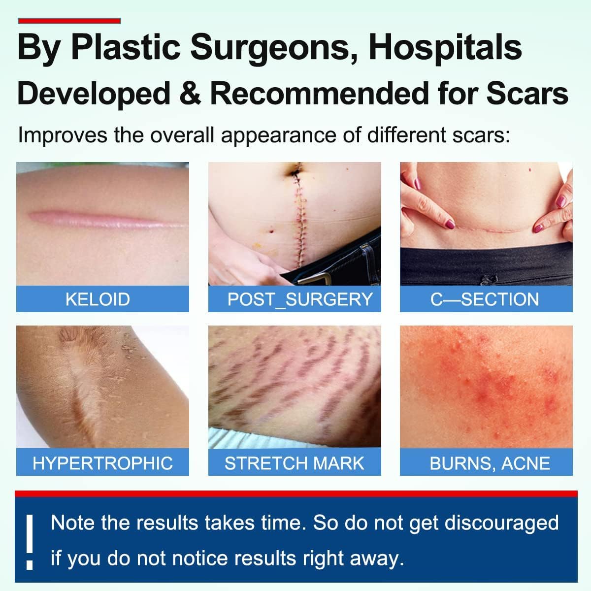 NIYANETAIL Scar Removal Tape β Medical-Grade Silicone Scar Sheets for C-Section, Acne, Keloid, Surgery & Tummy Tuck Scars | Reusable, Soft & Painless Scar Treatment Strips 2