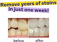 Vista 3 de BURST Tiras blanqueadoras dentales con aceite de coco calmante para sensibilidad, suaves con las encías, eliminación profunda de manchas, seguro