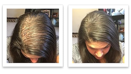 Miniatura 10 de Oculta puntos calvos y bordes calvos al instante. Haz que el cabello fino se vea 10 veces más lleno. Kit de inicio de fibra capilar Caboki (negro)