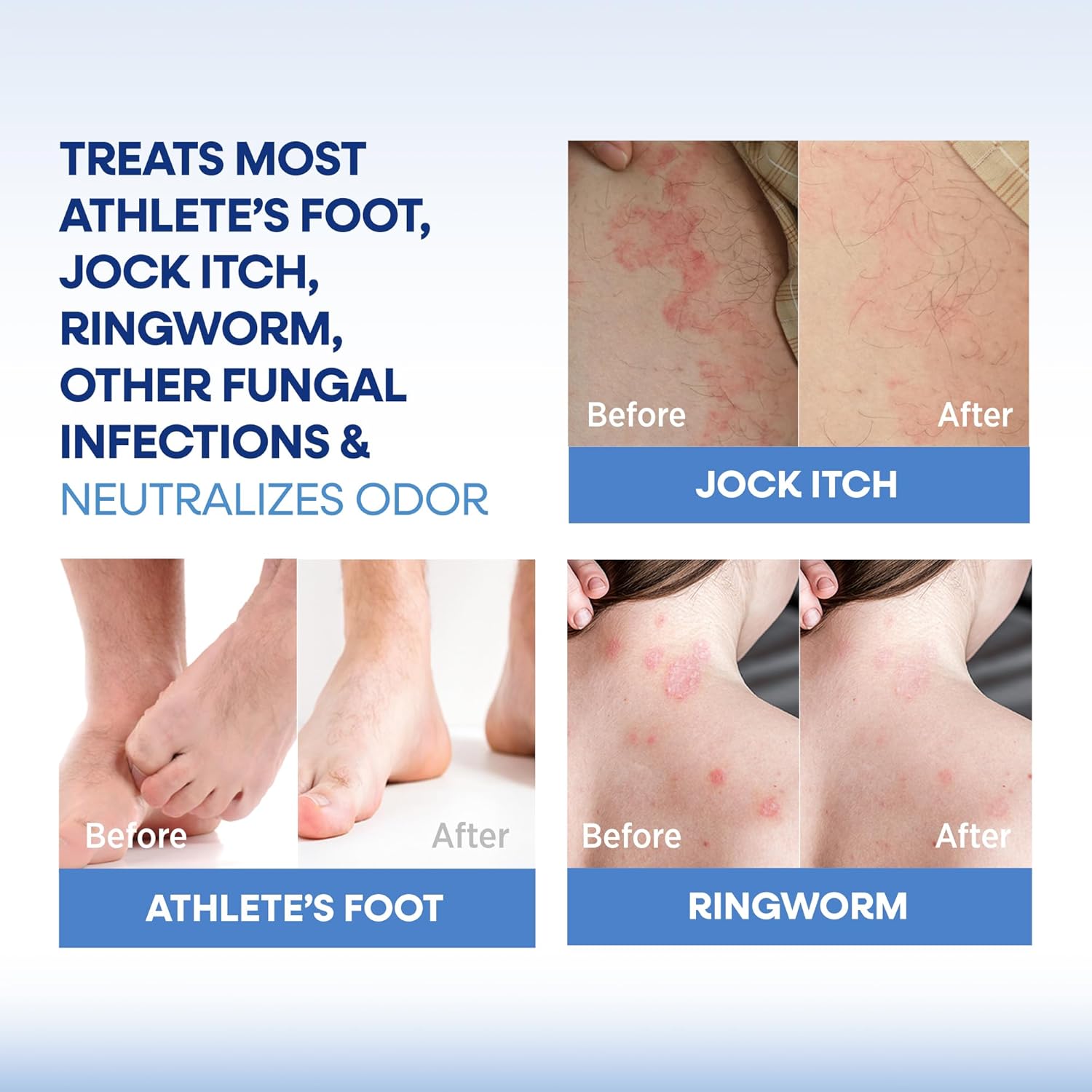 Hermon Antifungal Soap with Tea Tree Oil: Antifungal Treatment Bar Soothing Care & Relief of Itchy for Ringworm, Jock Itch, & Athlete's Foot - Body & Face Wash - Original & Lavender 4Pack