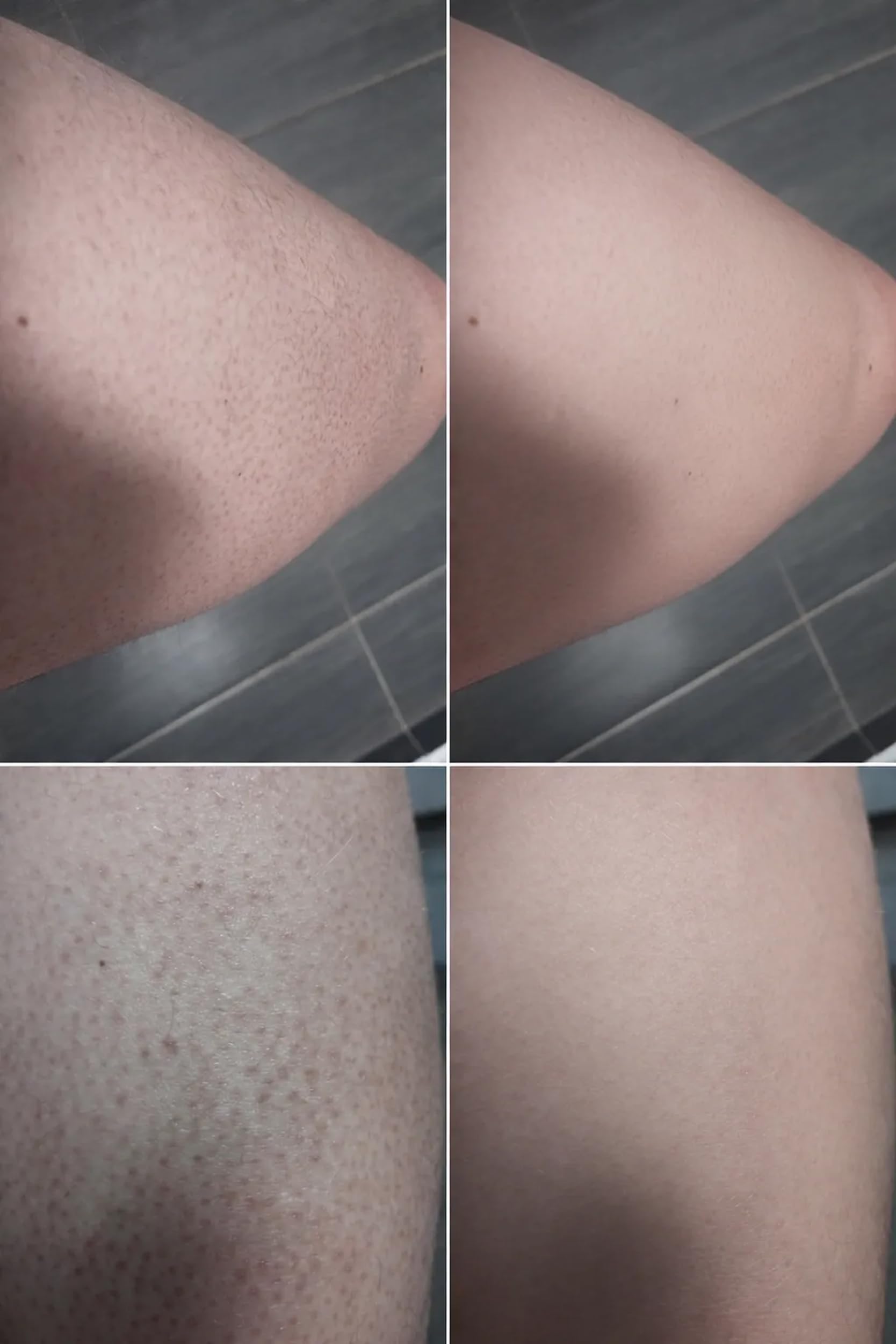 Gommage Corps Exfoliant kératose pilaire traitement, peau de fraise et poils incarnés – peeling chimique (AHA/BHA) + physique à double action à l’acide salicylique, acide glycolique et noyau d’abricot