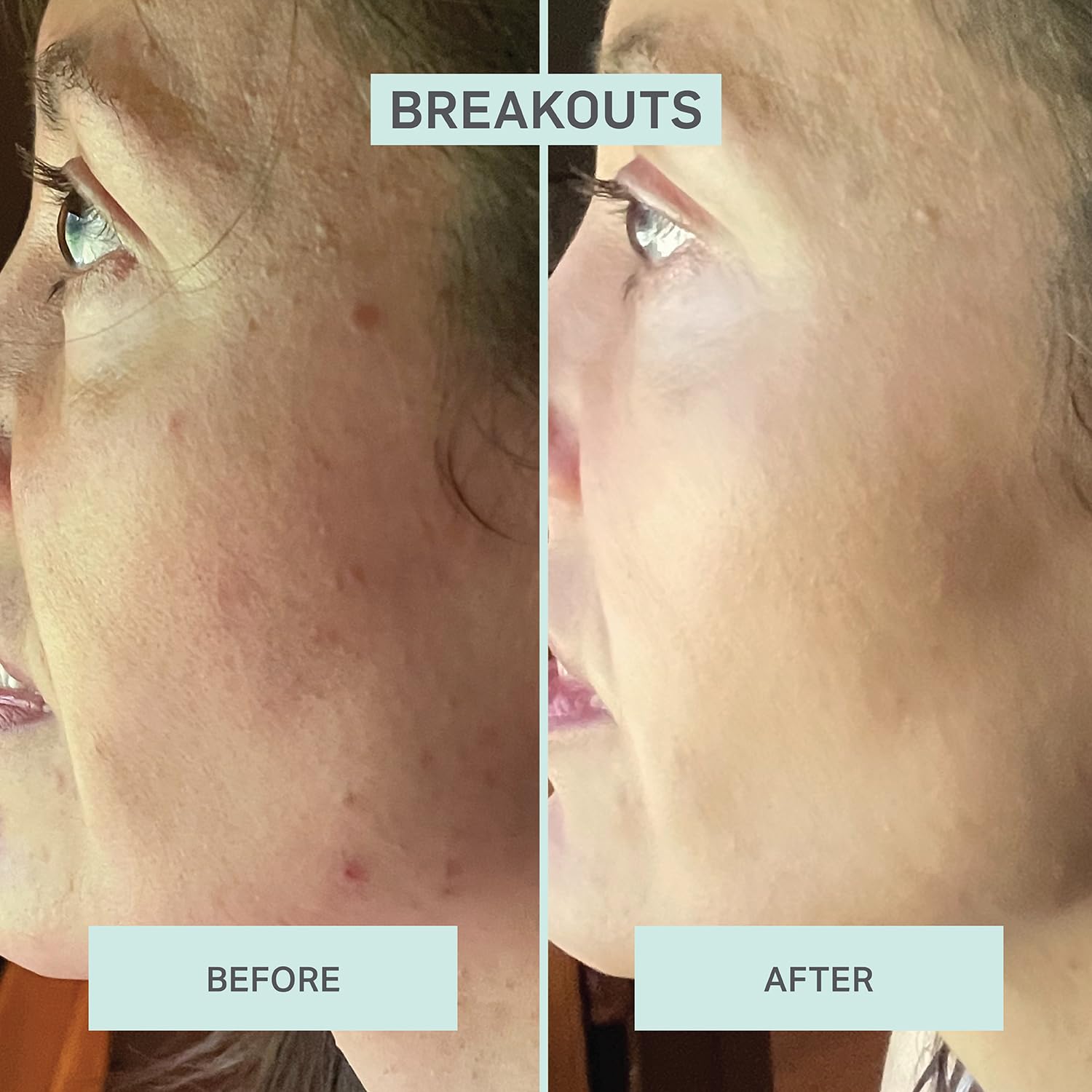 LUMION Save My Skin Hypochlorous Acid Serum – Balances, Soothes & Clarifies Skin | For Irritated & Breakout Prone Skin | All Skin Types (1.7 fl oz)