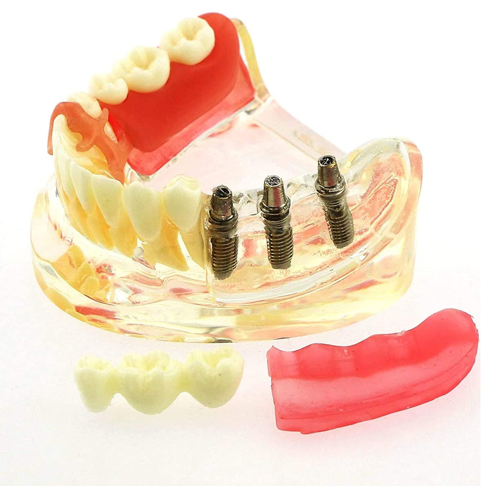 Dental Orthodontic Typodont Model - Implant & Denture Restoration Practice Model 12 thumbnail image