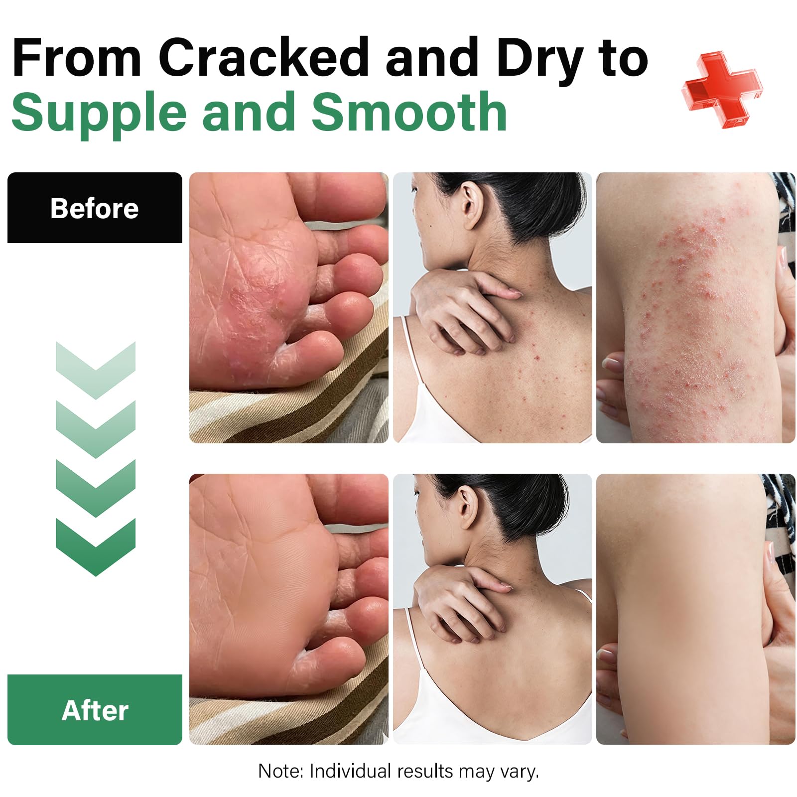Teebaumöl Antipilz-Creme – Natürliche Formel, sanfte Pflege für die Leisten- und Oberschenkelbereiche-Antifungal Cream with Tea Tree Oil