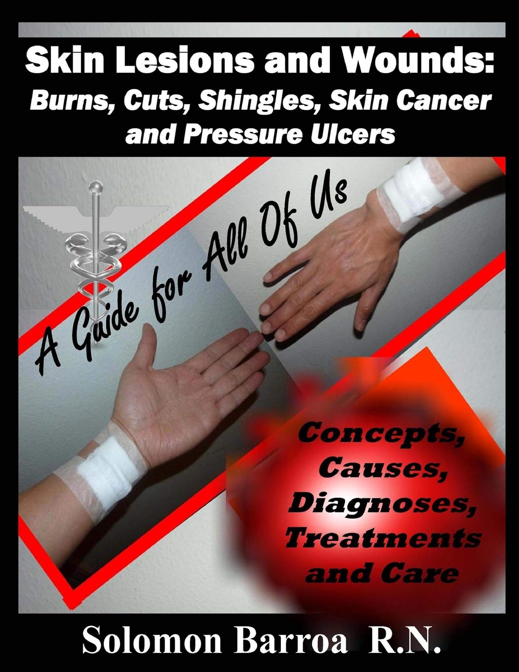 Solomon BarroaSkin Lesions and Wounds: Burns, Cuts, Shingles, Skin Cancer and Pressure Ul