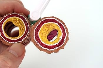 3B 血管模型 ★ 動脈硬化4段階モデル 「4-PIECE ARTERY」① 3B 血管模型 ☆ 動脈硬化4段階モデル 「4-PIECE ARTERY」①