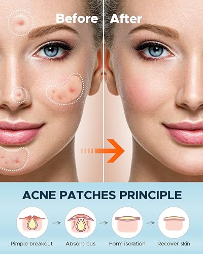 Miniatura 7 de LitBear Parches grandes para espinillas para acné, 6 tamaños, 100 parches para brotes grandes, parches de acné para cara, barbilla o cuerpo, parche