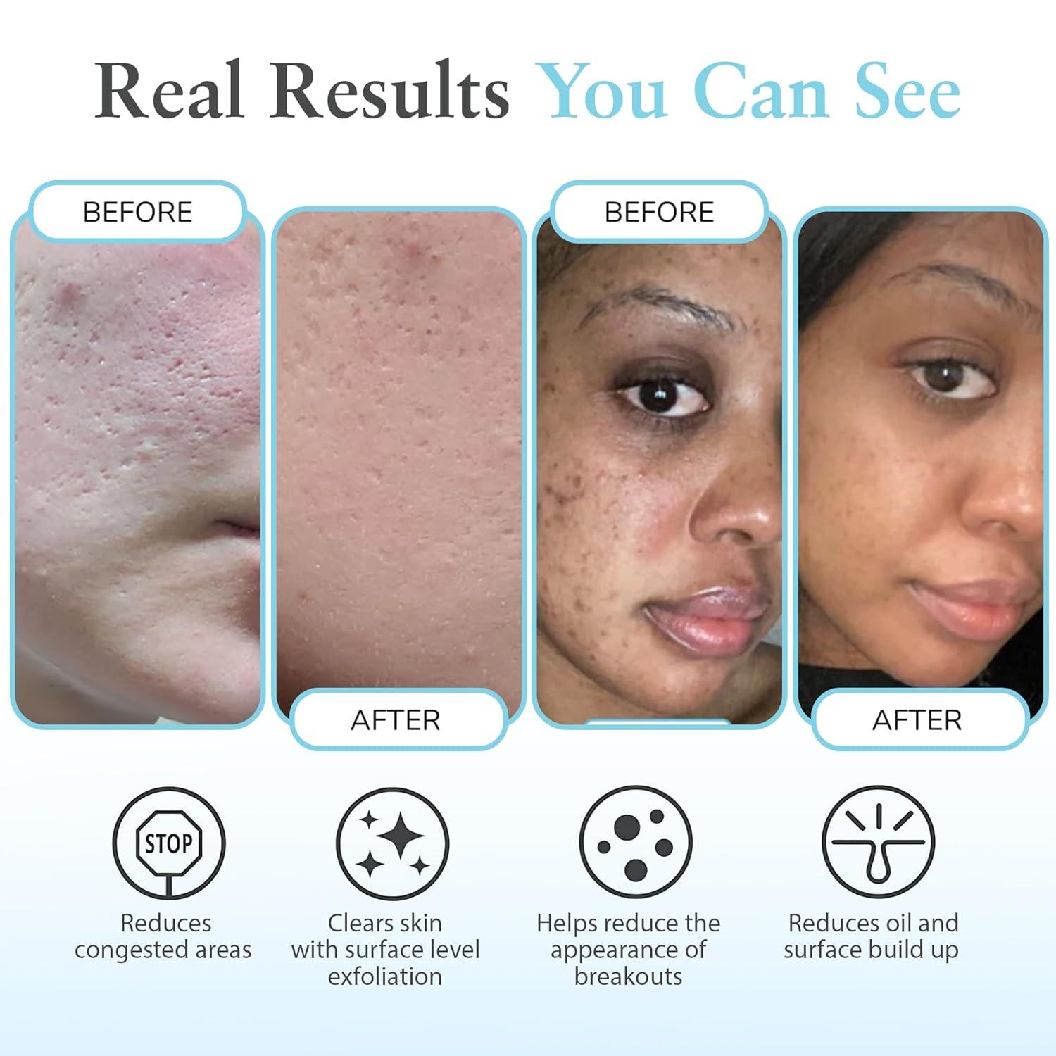 Salicylic 10% Gel Peel, Breakout and Pore Minimizer and Cleanser, 15-30 Full Facial Chemical Peels, 1 fl oz. e, 30 mL – Perfect Image - Image 4